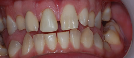 dental implants northern ireland