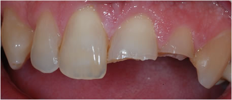 dental implants northern ireland