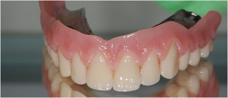 dental implants northern ireland