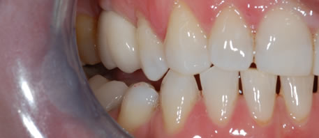 dental implants northern ireland