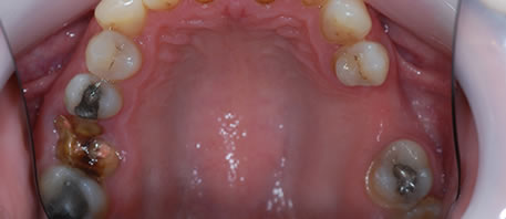 dental implants northern ireland