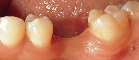 dental implants northern ireland