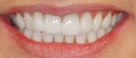 veneers  northern ireland