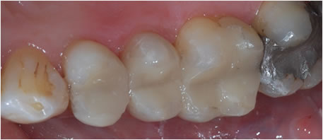 dental implants northern ireland