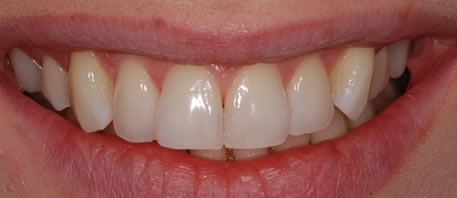 tooth whitening northern ireland