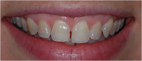 whitening northern ireland