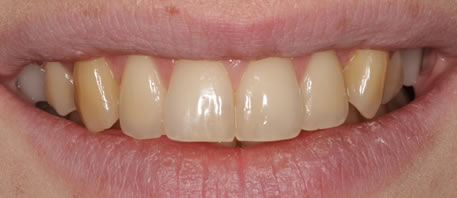 whitening northern ireland